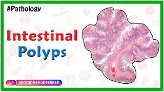 Intestinal polyps : Pathology lectures for fmge and neet pg