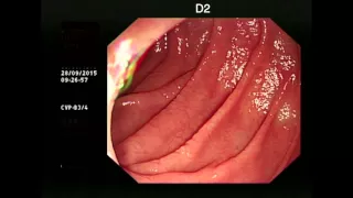 Coeliac Disease - typical endoscopic appearance