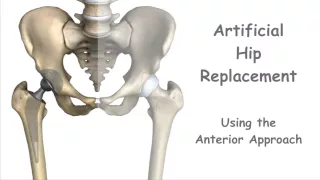 Artificial Hip Replacement - Anterior Approach