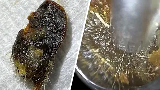 126 - Mammoth Ear Wax Removal with WAXscope®️ using Ear Hook & Zoom Feature!