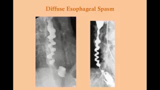 Esophageal Disorders (old version, with sound) - CRASH! Medical Review Series