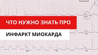 На что обращать внимание при ЭКГ диагностике инфаркта миокарда. (для врачей)