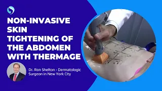 Tightening loose sagging abdominal skin with Thermage in NYC - Ron Shelton MD