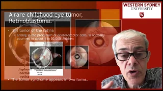 3.3 Retinoblastoma - a rare childhood eye tumor