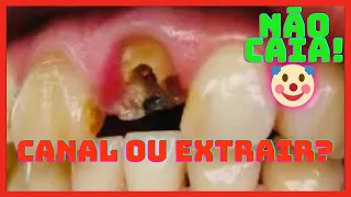 FAZER CANAL ou EXTRAIR o DENTE? NĀO DECIDA SEM VER ESSE VÍDEO ATÉ O FINAL!