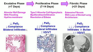 LIMITATIONS OF CURRENT APPROACHES TO DIAGNOSE OR PREDICT ARDS Massimo Antonelli 2015