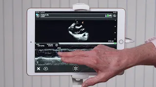 Clarius Feature: Ejection Fraction