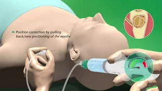 PAJUNK Animation NerveGuard Clinical 1 / RichardsMedical.com