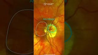 Posterior vitreous detachment & Retinal detachment.