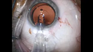 Sulcoflex Trifocal DUET surgery (Sulcoflex Trifocal + RayOne Aspheric Preloaded Injector system)