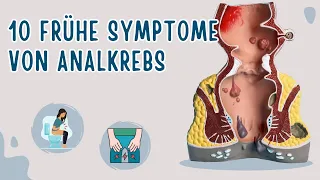 10 Frühe Symptome von Analkrebs, die du kennen musst