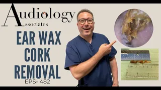 "CORK" OF EAR WAX REMOVED - EP482