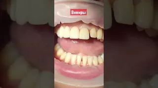 Виниры, красивые зубы, голливудская улыбка, стоматология