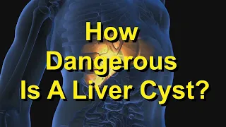 How Dangerous Is A Liver Cyst?
