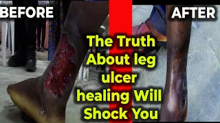 The Truth About leg ulcer healing Will Shock You --- Apostle Marcel #tbjoshua #emmanueltv #viral