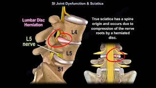 Sacroiliac join dysfunction  or Sciatica, the SI joint pain can mimic  spine  pain and sciatica.