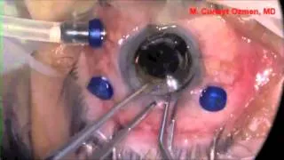 Pars Plana Vitrectomy with Temporary Keratoprosthesis and IOL Extraction