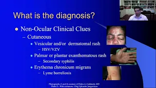 Lecture: Uveitis: Therapeutics Update