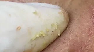 531 Treating Blackheads For Young Men   Điều Trị Mụn Đầu Đen Cho Bạn Nam Thiếu Niên   SacDepSpa#208