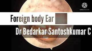 Foreign body Ear 👂