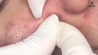 Full Blackhead Popping Video - HOT 2019 - Part 1