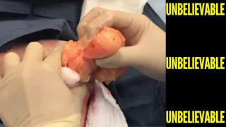 5 - Pimple Popping Compilation Most Popular Sebaceous Cyst Amazing Abscess On Nose of Poor little