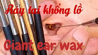 Giant Ear Wax || How to clean the ears of Vietnamese people