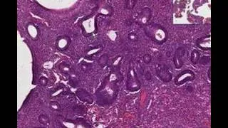 Histopathology Endometrium --Hyperplasia