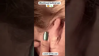 Blackhead Behind Ear #oddlysatisfying #sick #blackhead #pimplepopper #satisfying #cyst #wow #acne