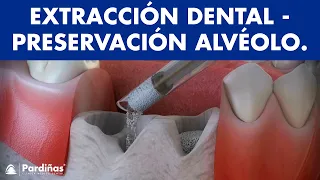 Extracciones dentales - Tratamiento de preservación alveolar ©