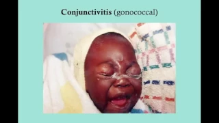 Conjunctivitis   CRASH! USMLE Step 2 and 3