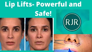 Lip Lifts- Powerful and Safe!