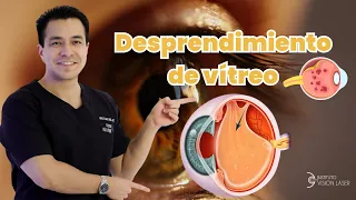 Desprendimiento de Vítreo