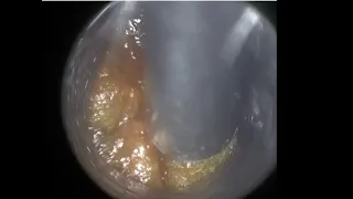 99 - Sticky & Wet Ear Wax Removal in Bendy Ear With WAXscope®️