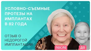 Как восстановить зубы недорого и качественно? Я выбрала условно-съемные протезы на имплантах