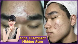 Acne Treatment | Điều trị mụn hiệu quả số 1 TPHCM | Hiền Vân Spa |Mụn bọc, mụn đầu đen|539