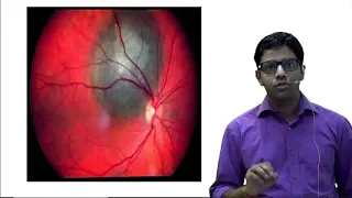 Medical Unplugged : Choroidal Melanoma