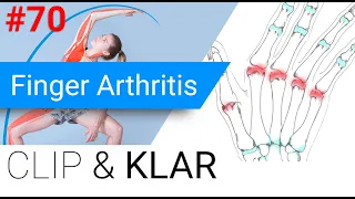 Finger Arthritis erklärt - Rheumatoide Arthritis, Psoriasis und Co.