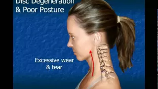 Cervical Disc Degeneration