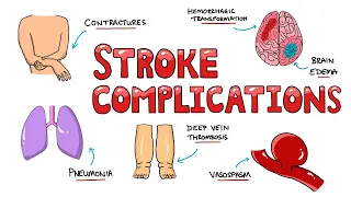 Post Stroke Complications - What are the most common complications of stroke?