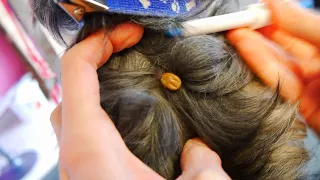 How to Remove a Huge Tick
