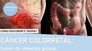 Tumor de intestino: entenda a doença divulgada por Preta Gil, como prevenir e tratar | Fernando Eyer
