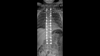 My Scoliosis story - spinal fusion