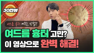 여드름 패인 흉터도 없앨 수 있을까?｜강남 피부과 원장이 다 알려줍니다!