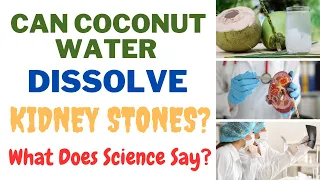Can Coconut Water Dissolve Kidney Stones? What Does Science Say?