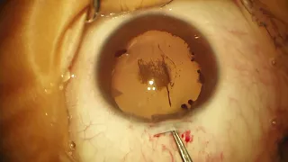 Surgery: Congenital Cataract with Pupillary Membrane: Dr. Stephen Lane