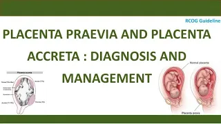 Diagnosis and Management of Placenta Praevia and Placenta Accreta, RCOG Guideline