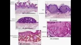 Dermatopathology101-Normal skin histology, non-neoplastic skin disorders, and skin cancers.mov