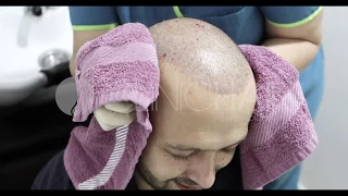 Washing the Donor Area After the Hair Transplant