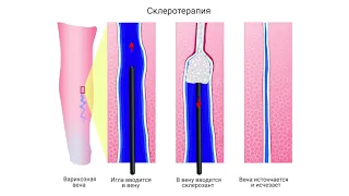 Варикозное расширение вен нижних конечностей. Лечение варикоза вен на ногах